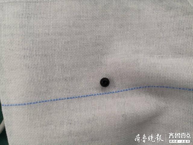 「超级宝妈」好险！1岁宝宝珠子卡喉，危急时刻济医附院耳鼻喉科成功救治