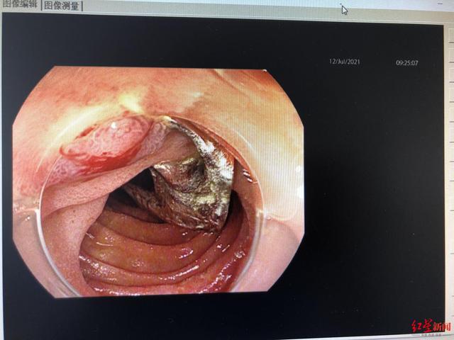 异物|男子吃橘子时不慎吞入牙套，一个多月后腹部疼痛 医生：进食莫匆忙