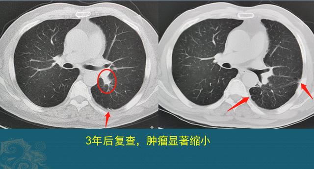 肺癌能治好吗？医生解释3个阶段的治疗数据，避免人财两空