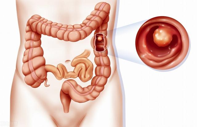 胃肠息肉患者术后依旧腹泻、腹胀？这些症状不消除，息肉难以去根