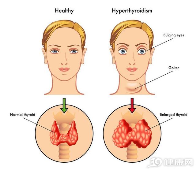 甲状腺结节|甲状腺结节癌变时，3个症状不会骗人，可要记清楚了