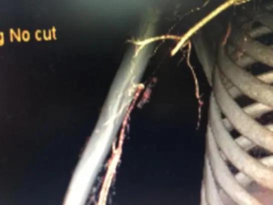 28岁小伙上肢缺血险坏死，医生以大隐静脉移植重建血管通路让他“绝处逢生”