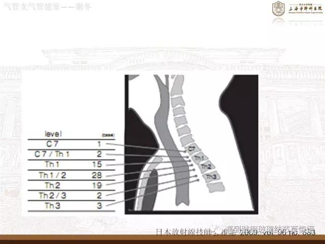 遇到气管、支气管憩室莫惊慌