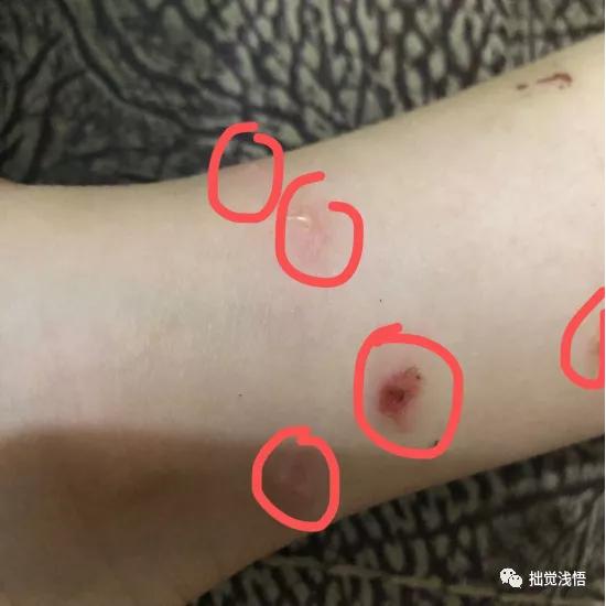 超级宝妈|小儿黄水疮