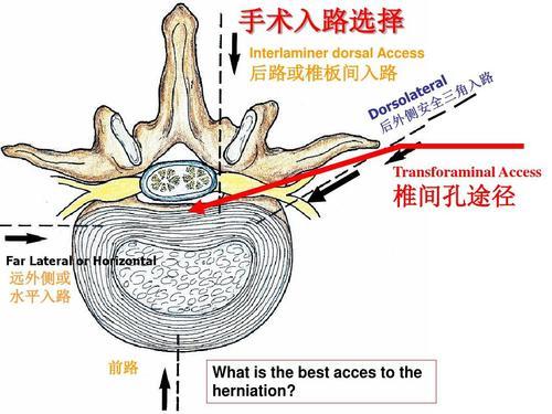 椎间孔镜|为什么颈椎病，肩膀疼痛会引起手臂麻木呢？在家要如何缓解