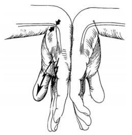 手麻|手麻不是小问题！尤其是这种手麻，与脑梗相关
