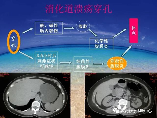 消化道穿孔的CT诊断