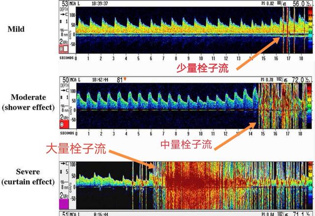 45岁男子反复头痛折磨6年，伴有脑梗，原来是心脏有个破“洞”