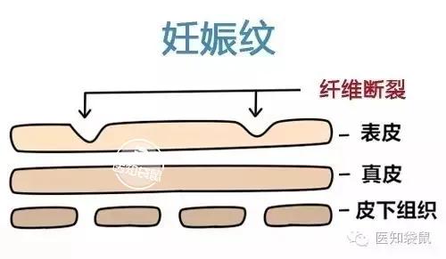 「你的育儿经」坚持抹橄榄油就能祛除妊娠纹？别逗了