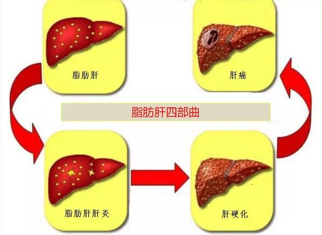 胆固醇超标有哪些并发症？高胆固醇患者饮食上要注意3点，留意下