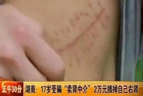 虚荣高中生“卖肾”换苹果手机，如今人和身体都“废了”