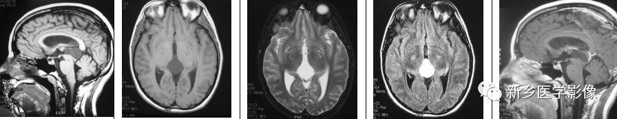 12种松果体区肿瘤的影像表现