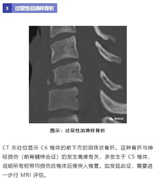 影像经验！脊柱的 13 个影像学特征