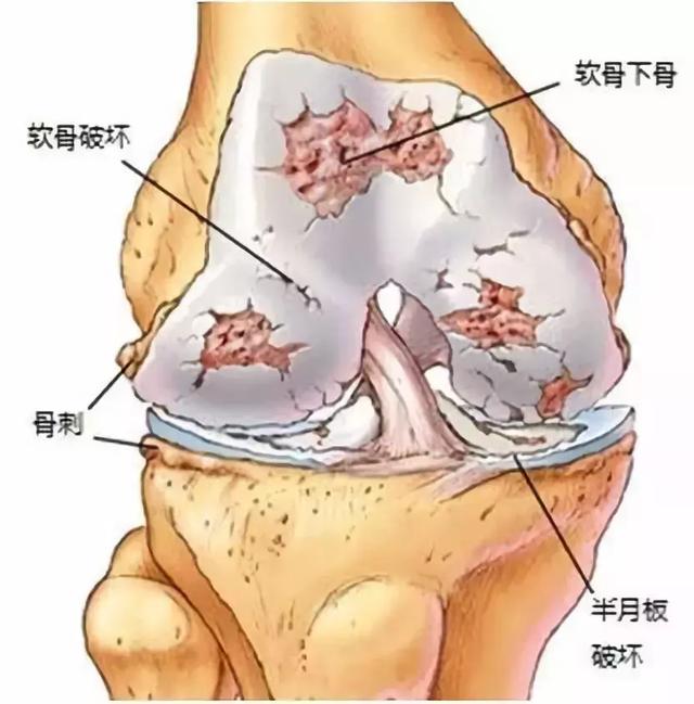 生理年龄|为何大多数老年人都会膝关节疼痛？如何破解？