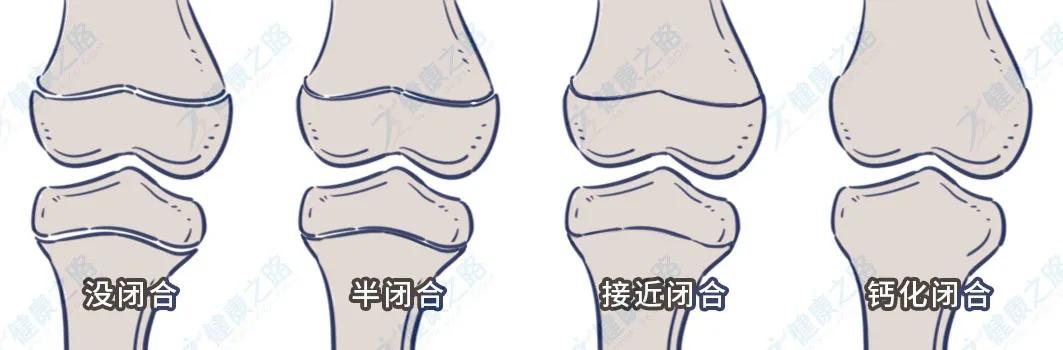 「你的育儿经」骨折、扁平足、O/X型腿…儿童骨病要重视，及早去看「小儿骨科」