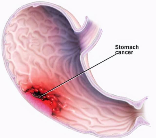 「胃癌」能筛查吗？医生：5种肿瘤标志物，筛查和判断转移很关键