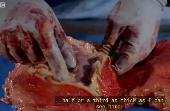 体重|一半国人超重！看完胖子的解剖内脏，只想减肥！