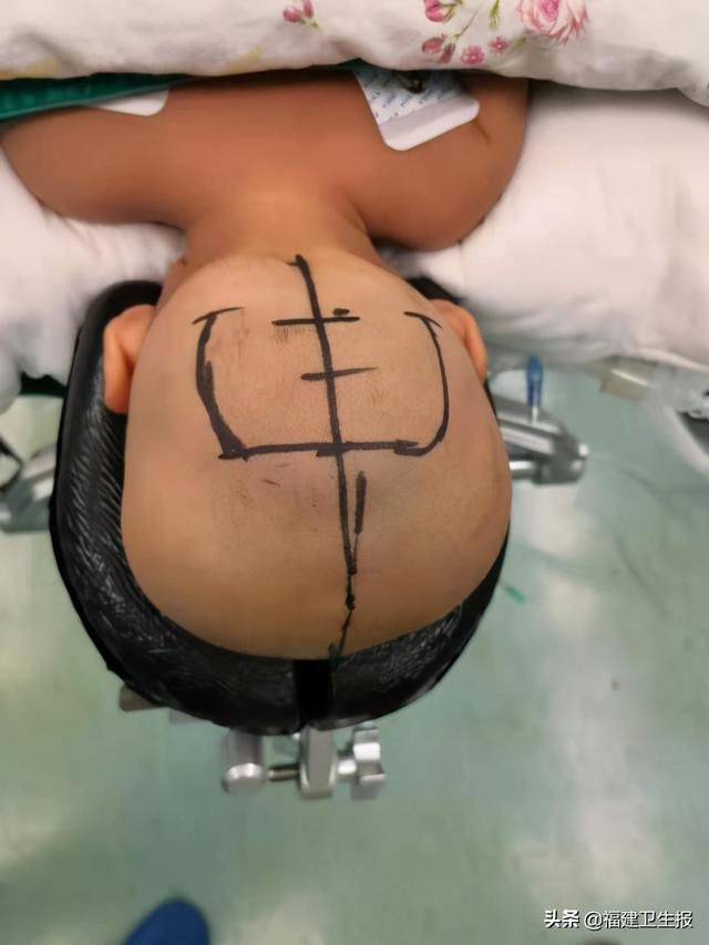 出血|厦门1岁宝宝在家摔倒，颅内巨大血肿全然不知！孩子磕碰摔伤，这些紧急处理千万别做错