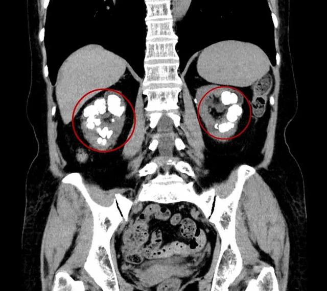 结石|小“石头”引发大问题，竟比癌症更危险