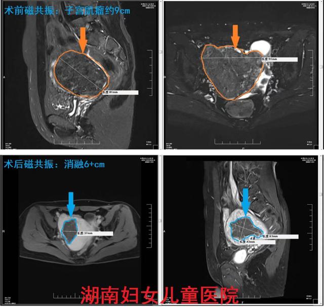 肌瘤|海扶刀无创治疗9厘米子宫肌瘤实现“隔山打瘤”