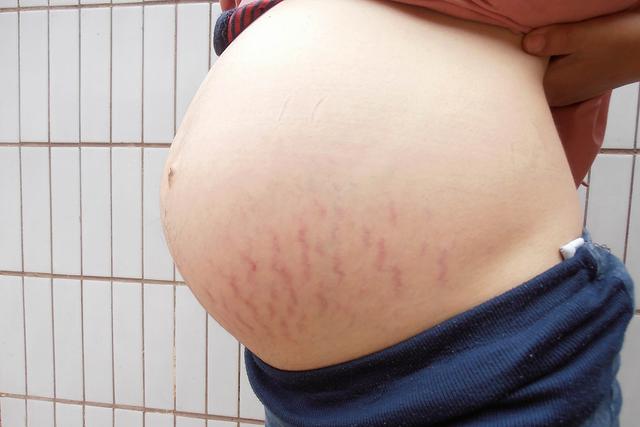 「你的育儿经」让人“讨厌”的妊娠纹,有4类人却可以避开,如果全中那恭喜你了