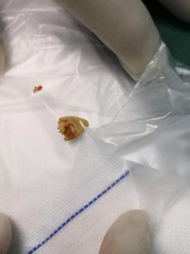 【你的育儿经】4岁男孩咳嗽不止!医生竟在肺里找到这个