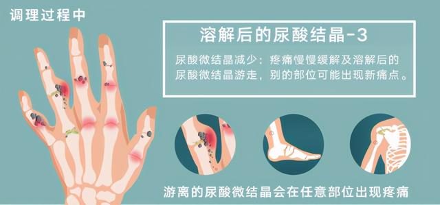 尿酸值下降，为何痛风更频繁？专家：这是好转的信号，别担心