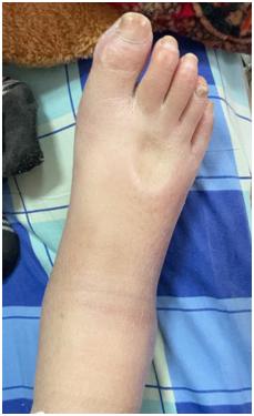 心脏|脚上一按一个坑！五旬大妈心上长了层“铠甲”，看医生如何化险为夷