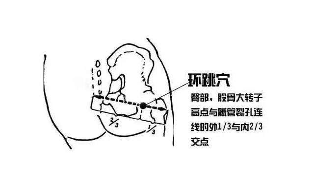 环跳穴，髋部及下肢疼痛的要穴；医生说：有三个功效，一个待验证