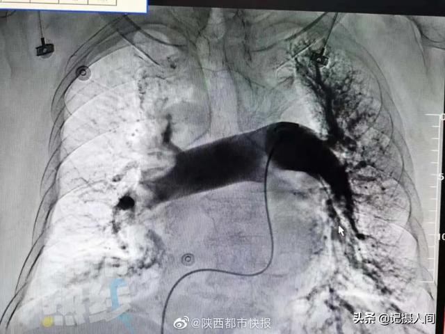 西安78岁老太危急送医，家有老人的，这件事一定要注意了……