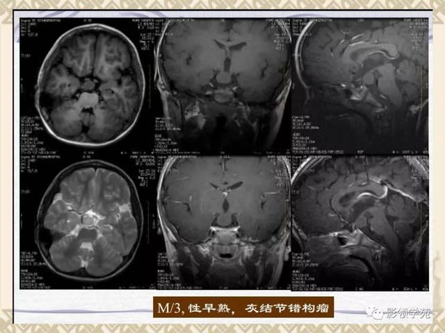 垂体病变的MRI诊断