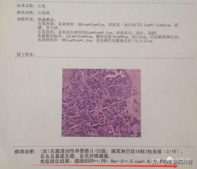 医患通用——3分钟看懂病理报告