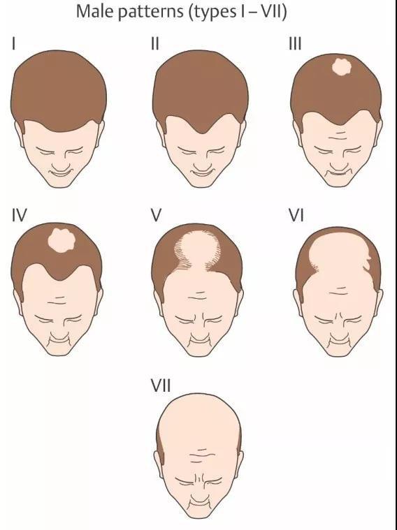 脱发常见的3种类型及应对办法，快来对号入座拯救头发