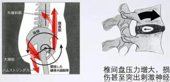 非特异性|有一种腰痛是因为屁股不够翘