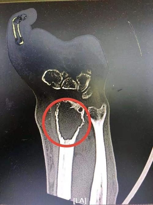 医院|手骨中长了“贪吃蛇”，两年吃掉6厘米骨头