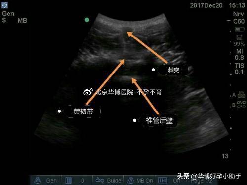 梦的色彩|据说肉肉多，生孩子不能打无痛？