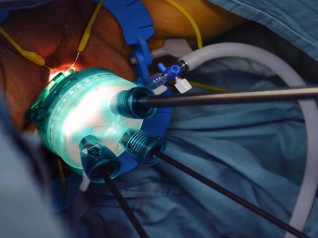 肛门|直肠癌复发，要保命，就无法保肛？微创给出了另外一个答案……