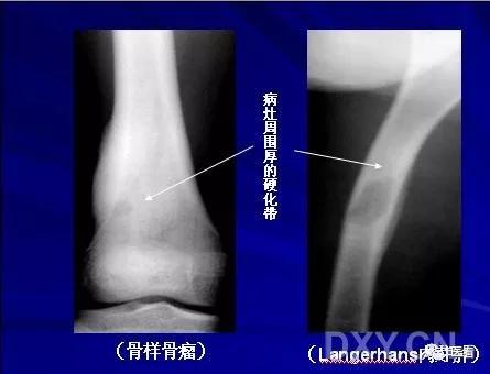 9个骨肿瘤医学影像诊断分析基本要点，如此精彩怎能错过