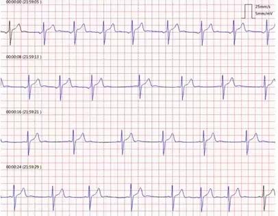心电图|心电图“窦性心律不齐”是怎么回事儿？