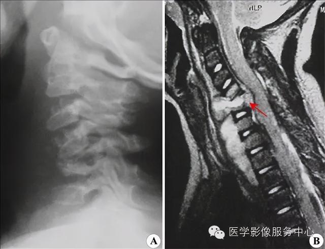 77种骨肌影像病例，助你诊断无忧