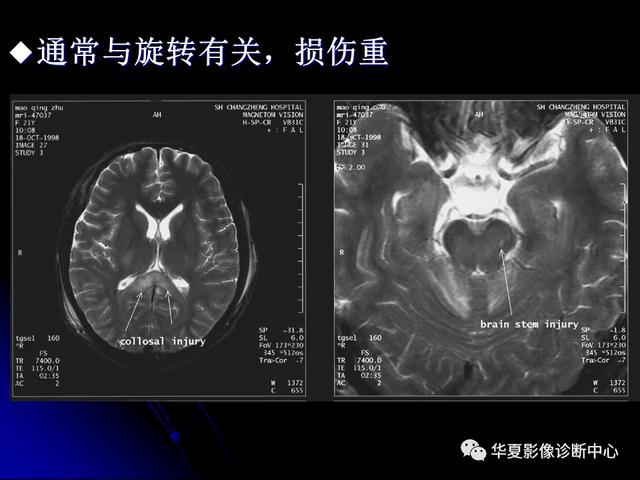 「影像复习」脑干区常见病变影像表现