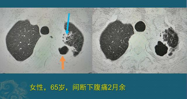 肺结核病人与肥皂的缘分，医生教你用CT片诊断肺结核