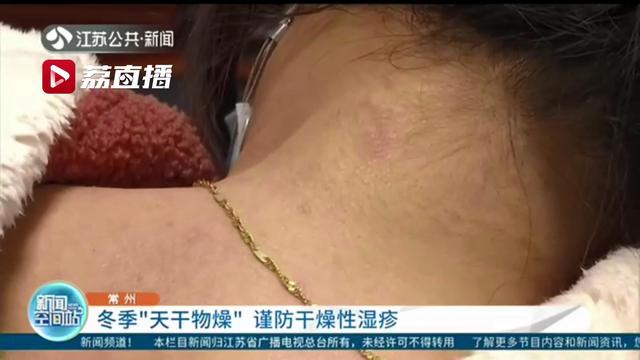 冬季天干物燥谨防干燥性湿疹 医生：合理运用润肤剂可有效预防或改善