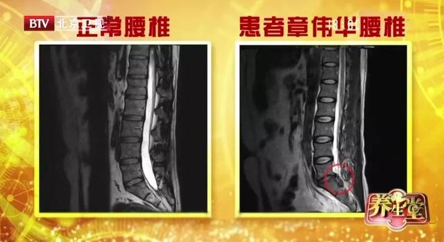 膝关节|天一冷，膝盖就痛？教你2个简单小测试，找出腰腿小毛病