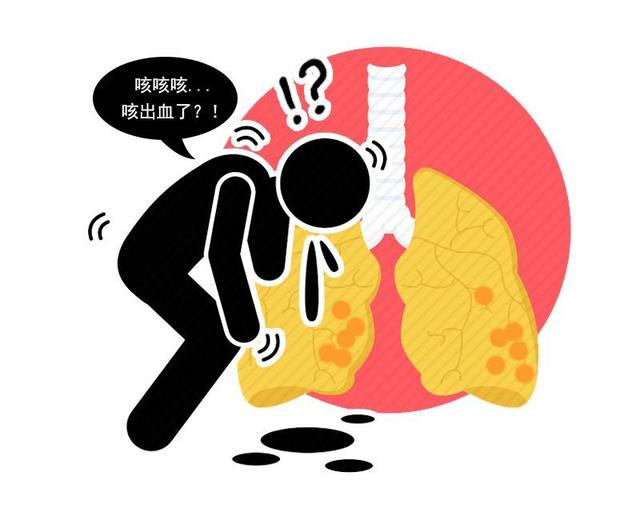 3个症状，是肺癌早期的“高危信号”！此类咳嗽容易被忽视