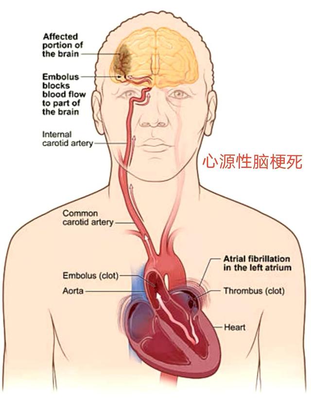 最新证据：老年人的脑梗死预防的研究进展