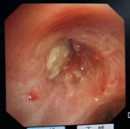 医生|气管里进了“不速之客”？！气管镜在此，休得放肆