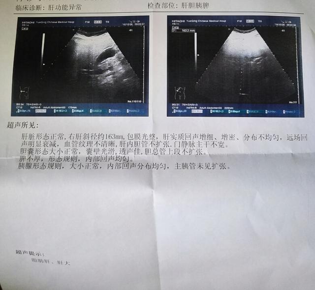 患了脂肪肝不能吃肉？医生提醒：脂肪肝可逆转，这5种错不要犯