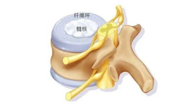 硬板床|睡硬板床硌得浑身痛，却能改善腰椎间盘突出？