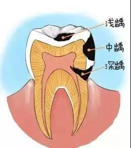 补牙，为啥不能一次完成？补牙后为什么还是牙疼？